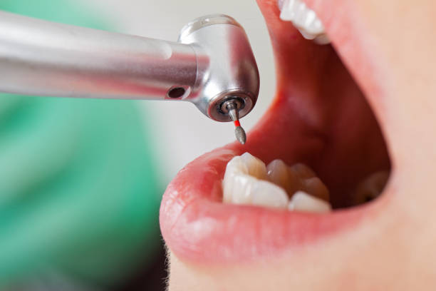 Best Emergency Tooth Extraction in Fruitland, IA